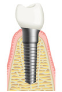 Rotationssymmetrisches Implantat mit Zahnersatz (Krone) 