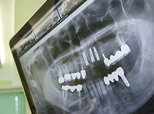 Ziehen zahn kieferknochenentzündung nach Zahn gezogen:
