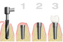 1. Geschlossene Einheilung; 2. Freilegung des Implantats, 3. Versorgung mit Zahnersatz