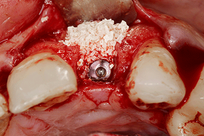 Implantat mit KEM im Oberkiefer 